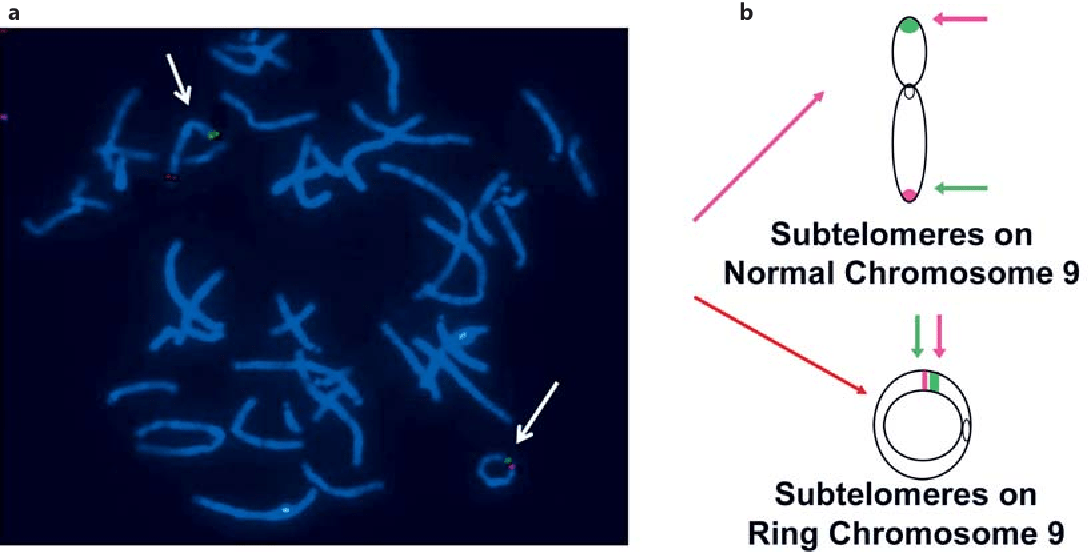 A Comprehensive and Clinical Review of Chromosome 9 Ring Syndrome